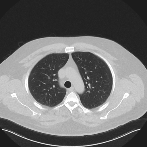 Normal HRCT (Radiopaedia 40797-43458 Axial lung window 18).png