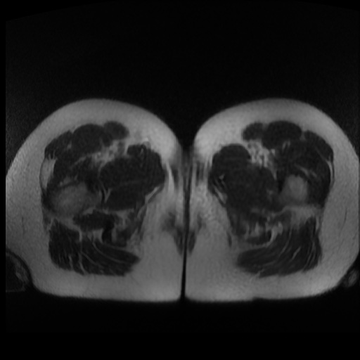 Normal MRI abdomen in pregnancy (Radiopaedia 88003-104546 Axial T2 57).jpg