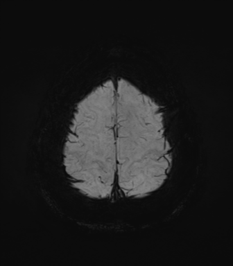 Normal MRI internal auditory canal (Radiopaedia 41613-44525 Axial SWI MIP 71).png