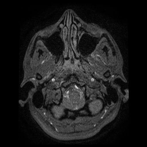 Normal brain MRA (Radiopaedia 41046-43793 Axial MRA 117).png