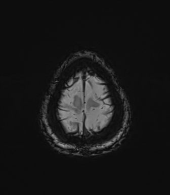 Normal brain MRI (TLE protocol) (Radiopaedia 40748-43405 Axial SWI 82).png