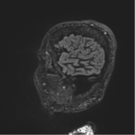 Normal brain MRI (non-focal epilepsy protocol) (Radiopaedia 53917-60040 Sagittal DIR 12).png