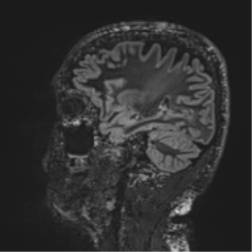 Normal brain MRI (non-focal epilepsy protocol) (Radiopaedia 53917-60040 Sagittal DIR 23).png