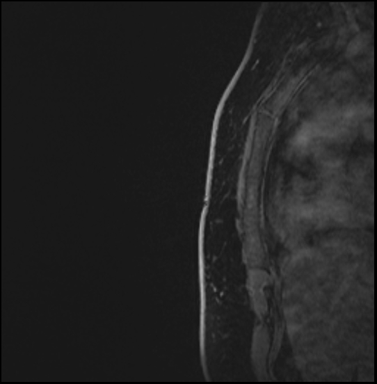 Normal breast MRI - dense breasts (Radiopaedia 80454-93850 I 183).jpg