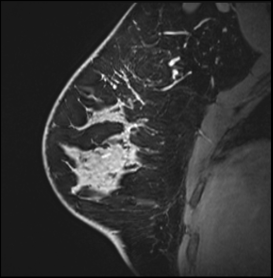 Normal breast MRI - dense breasts (Radiopaedia 80454-93850 I 60).jpg