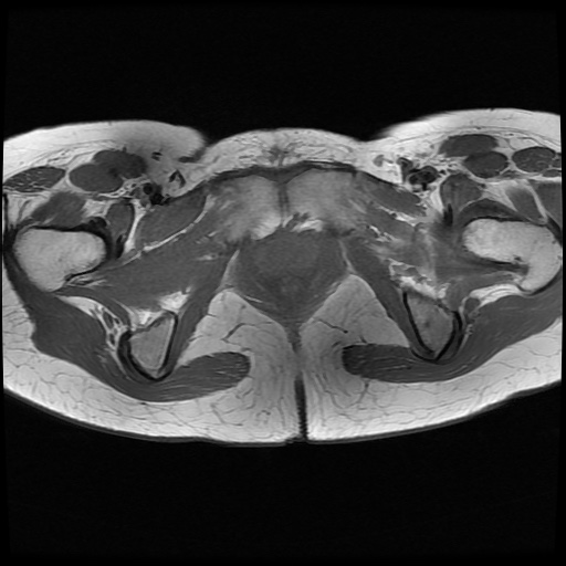 File:Normal female pelvis MRI (retroverted uterus) (Radiopaedia 61832-69933 Axial T1 26).jpg