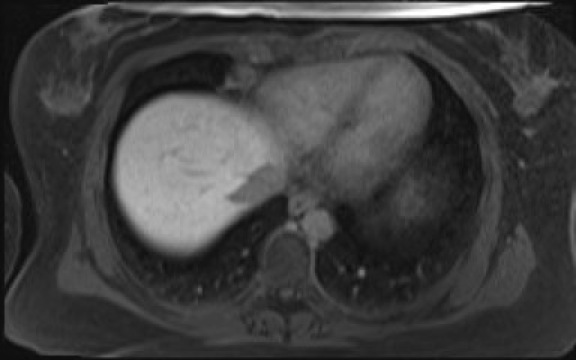 File:Normal hepatobiliary phase liver MRI (Radiopaedia 58968-66230 A 14).jpg