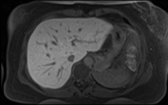 File:Normal hepatobiliary phase liver MRI (Radiopaedia 58968-66230 A 28).jpg