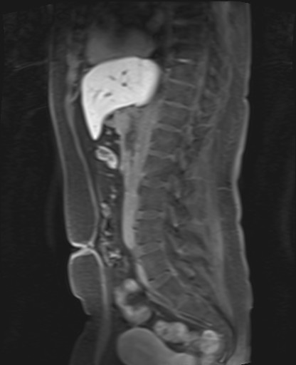 File:Normal hepatobiliary phase liver MRI (Radiopaedia 58968-66230 C 42).jpg