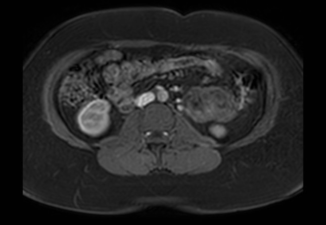 Normal liver MRI with Gadolinium (Radiopaedia 58913-66163 J 4).jpg
