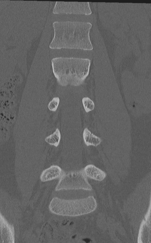 Normal lumbar spine CT (Radiopaedia 46533-50986 Coronal bone window 36).png
