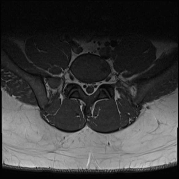 File:Normal lumbar spine MRI (Radiopaedia 47857-52609 Axial T1 26).jpg