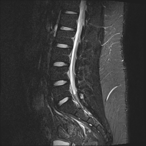 File:Normal lumbar spine MRI (Radiopaedia 47857-52609 Sagittal STIR 12).jpg