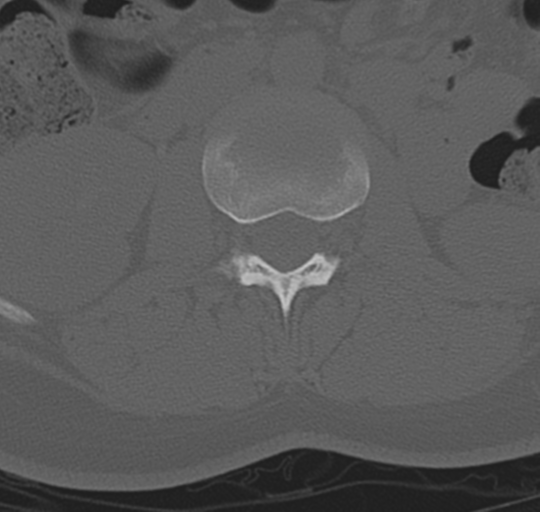 File:Normal lumbosacral CT (Radiopaedia 37923-39867 Axial bone window 43).png