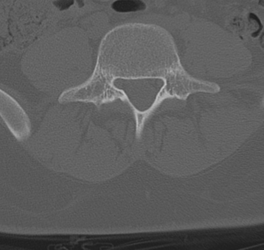 File:Normal lumbosacral CT (Radiopaedia 37923-39867 Axial bone window 72).png