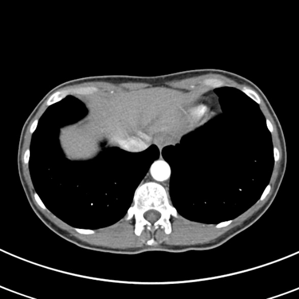 File:Normal multiphase CT liver (Radiopaedia 38026-39996 B 7).jpg