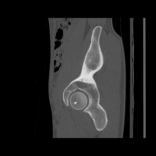 Normal pelvis (Radiopaedia 51473-57238 Sagittal bone window 42).jpg