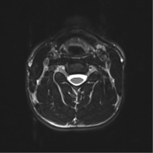 Normal trauma cervical spine (Radiopaedia 41017-43762 D 23).png