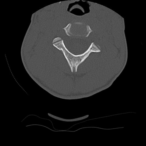 Normal trauma spine imaging (age 16) (Radiopaedia 45335-49358 Axial bone window 25).jpg