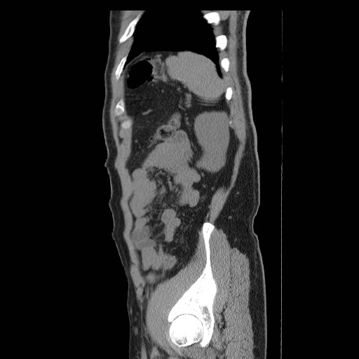 File:Obstructed kidney with perinephric urinoma (Radiopaedia 26889-27066 B 53).jpg