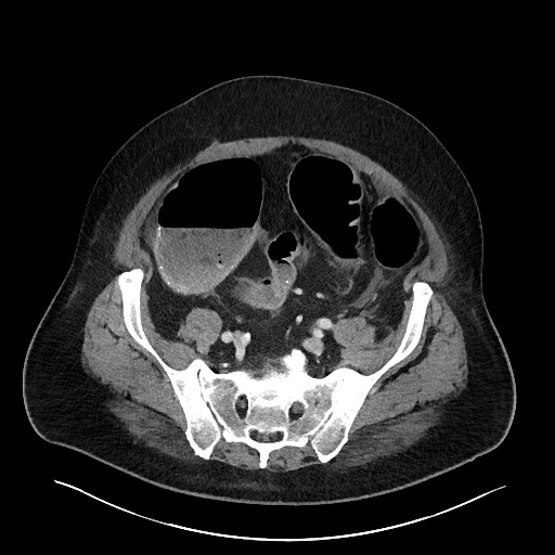Obstructing sigmoid adenocarcinoma (Radiopaedia 58465-65619 A 124).jpg