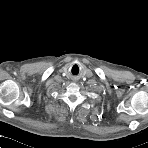 File:Obstructive superior vena cava tumor thrombus (Radiopaedia 28046-28306 A 1).jpg