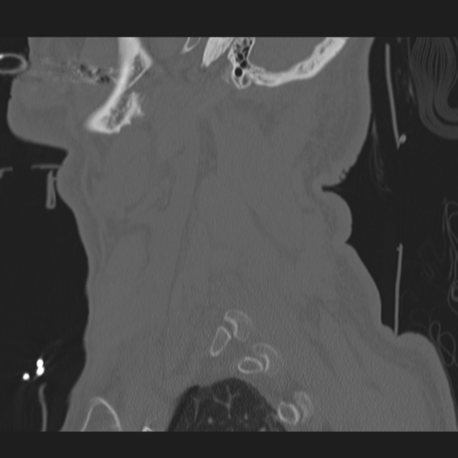 File:Occipital condyle fracture (Radiopaedia 33467-34517 Sagittal bone window 64).png