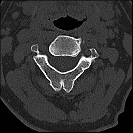 Occipital condyle fracture (type 1) (Radiopaedia 87670-104084 Axial bone window 31).jpg