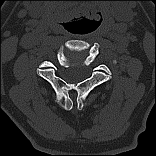 Occipital condyle fracture (type 1) (Radiopaedia 87670-104084 Axial bone window 34).jpg