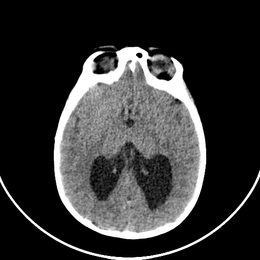 Occipital encephalocele (Radiopaedia 87339-103636 Axial non-contrast 43).jpg