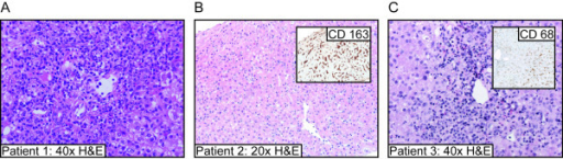 a-c)Liver biopsy results for three individuals with acute hepatitis (and SJIA)