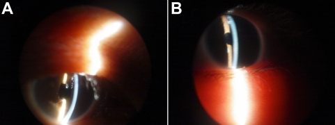 a,b) Two individuals with congenital cataract (and microcornea)