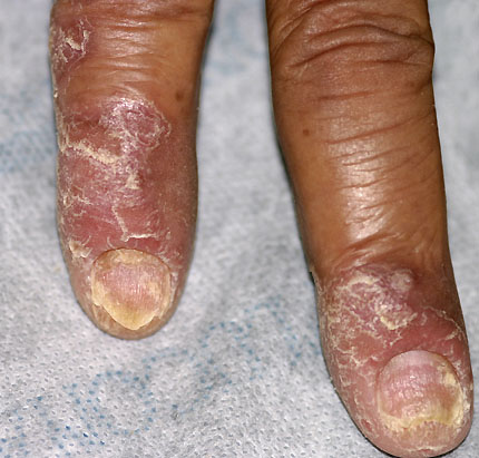 File:Psoriasis (Dermatology Atlas 37).jpg