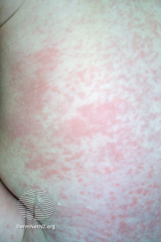 File:Rubella rash (DermNet NZ viral-rubella1).jpg