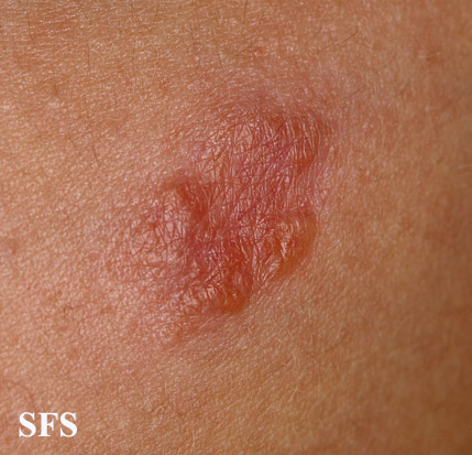 File:Sarcoidosis (Dermatology Atlas 30).jpg