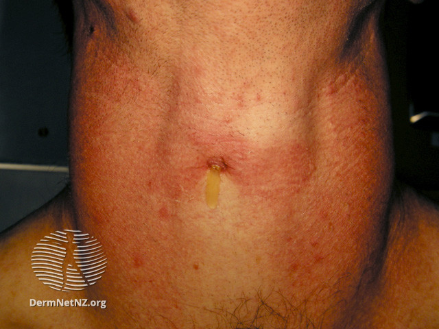 File:Thyroid goitre (DermNet NZ systemic-hyperthyroidism-2).jpg