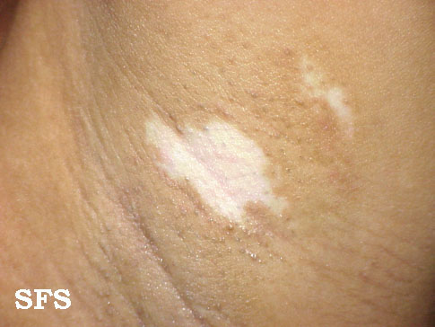 File:Vitiligo (Dermatology Atlas 17).jpg