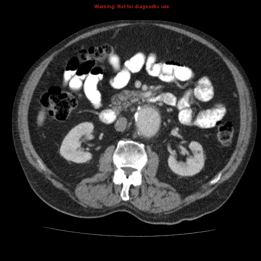 Abdominal aortic aneurysm (Radiopaedia 10122-10660 Axial C+ portal venous phase 33).jpg