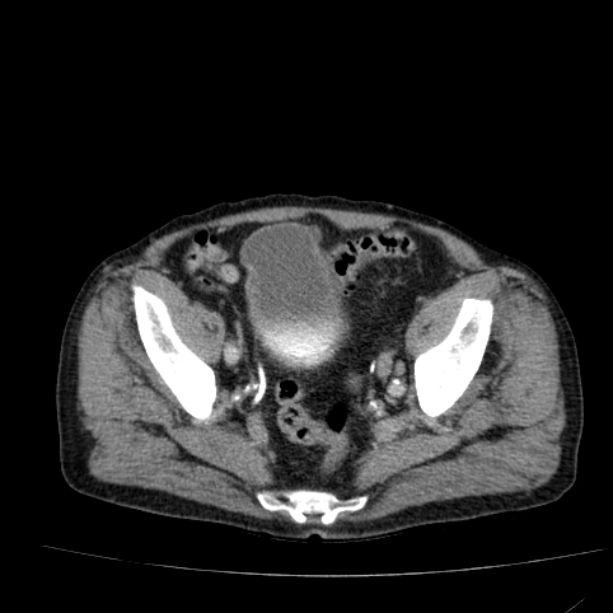 Abdominal aortic aneurysm (Radiopaedia 29248-29660 Axial C+ portal venous phase 52).jpg