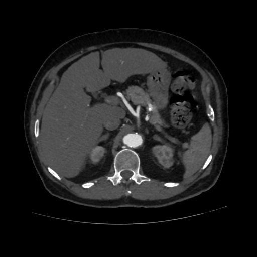 File:Abdominal aortic aneurysm (Radiopaedia 57318-64259 Axial C+ arterial phase 20).jpg