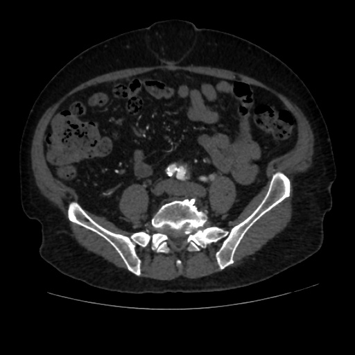 File:Abdominal aortic aneurysm (Radiopaedia 57318-64259 Axial C+ arterial phase 50).jpg