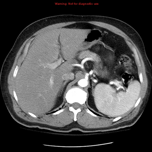 File:Abdominal aortic aneurysm (Radiopaedia 8190-9038 Axial C+ arterial phase 23).jpg