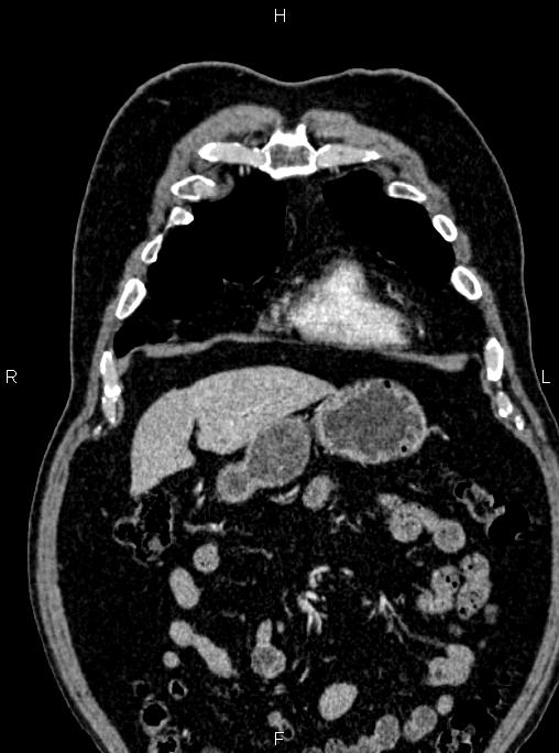 Abdominal aortic aneurysm (Radiopaedia 83094-97462 Coronal renal cortical phase 26).jpg