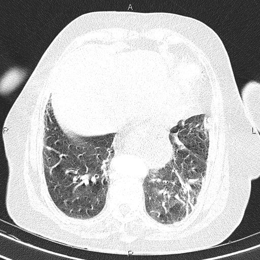 Abdominal aortic aneurysm (Radiopaedia 85063-100606 Axial lung window 49).jpg