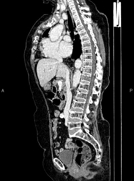 Abdominal aortic aneurysm (Radiopaedia 85063-100606 Sagittal C+ arterial phase 38).jpg