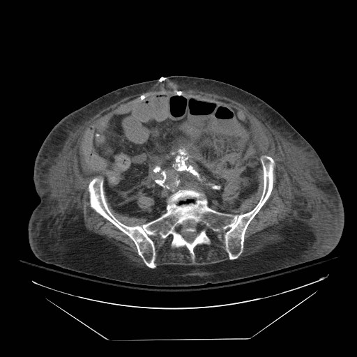 Abdominal aortic aneurysm - impending rupture (Radiopaedia 19233-19247 Axial non-contrast 118).jpg