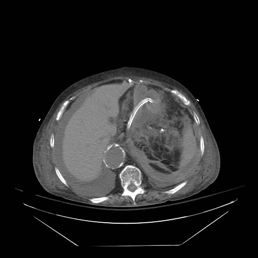 Abdominal aortic aneurysm - impending rupture (Radiopaedia 19233-19247 Axial non-contrast 44).jpg
