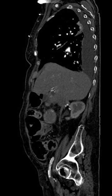 Abdominal aortic aneurysm with thrombus fissuration (Radiopaedia 73192-83919 Sagittal C+ arterial phase 102).jpg