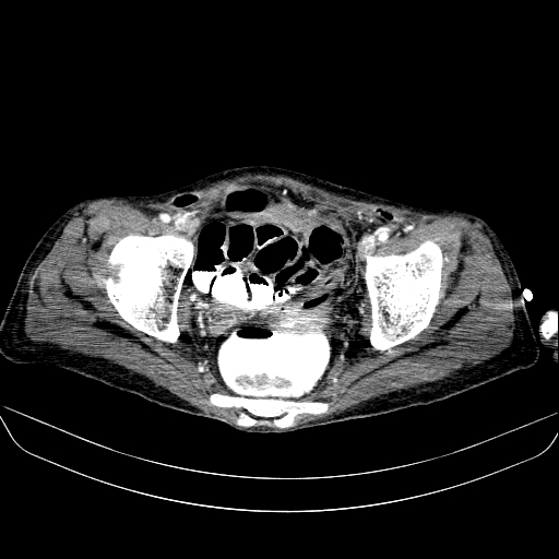 File:Abdominal collection due to previous cecal perforation (Radiopaedia 80831-94320 Axial C+ portal venous phase 184).jpg