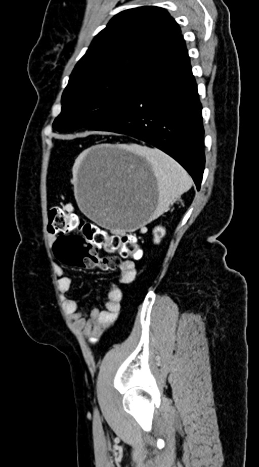Abdominal hydatid disease (Radiopaedia 68223-77737 Sagittal C+ portal venous phase 14).jpg